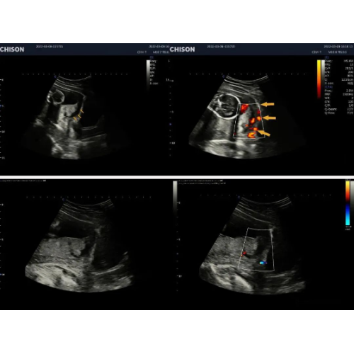 placental abruption ultrasound